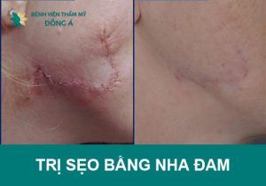 7+ cách trị sẹo bằng nha đam đánh bay sẹo rỗ, thâm, lồi ngay tại nhà