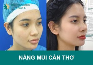 Top 1 địa chỉ nâng mũi tại Cần Thơ Đẹp, An toàn, Uy tín nhất