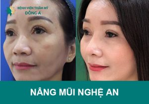 Review Top địa chỉ nâng mũi Nghệ An chất lượng, giá cả hợp lý?