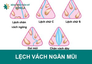 Lệch vách ngăn mũi có nguy hiểm không? Điều trị như thế nào?