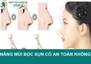 Nâng mũi bọc sụn có an toàn không? Có vĩnh viễn không?