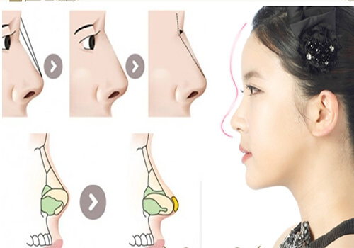 nâng mũi bọc sụn có đau không