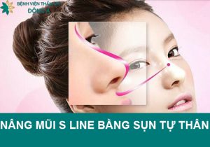 Nâng mũi S line bằng sụn tự thân là gì? Kỹ thuật an toàn, hiệu quả cao