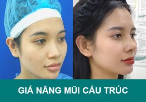 Giá nâng mũi cấu trúc hết bao nhiêu? Có phải càng đắt càng chất lượng?