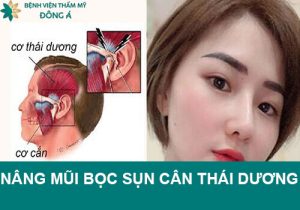 Nâng mũi bọc sụn cân cơ thái dương là gì? Ưu, nhược điểm