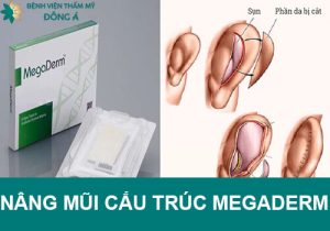 Nâng mũi cấu trúc bọc sụn Megaderm là gì? Có nên làm không?