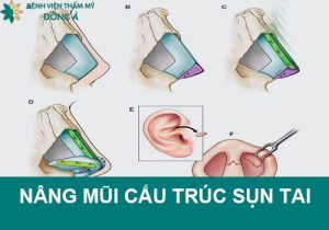 Nâng mũi cấu trúc bọc sụn tai là gì? Có an toàn, vĩnh viễn không?