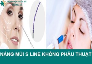 Nâng mũi S line không phẫu thuật – lựa chọn của nhiều khách hàng