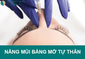 Nâng mũi bằng mỡ tự thân là gì? Có nên cấy mỡ vào mũi không?