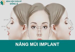 Kỹ thuật nâng mũi Implant và những thông tin liên quan nên biết