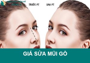 Giá sửa mũi gồ hết bao nhiêu? Nhân tố nào ảnh hưởng đến giá?