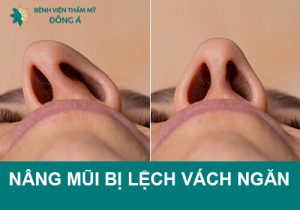 Nâng mũi bị lệch/vẹo vách ngăn mũi có sửa được không?