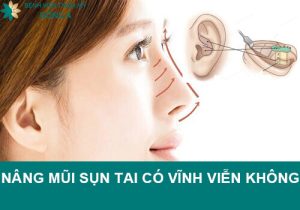 Nâng mũi bọc sụn tai có vĩnh viễn không? Duy trì vẻ đẹp bao lâu?