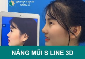 Nâng mũi S Line 3D Bệnh viện Thẩm mỹ Đông Á