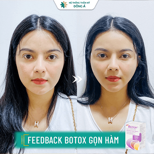 botox gọn hàm