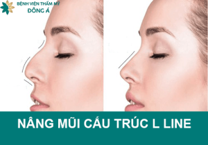 Nâng mũi cấu trúc L line – xu hướng thẩm mỹ đón đầu thị trường