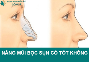 Nâng mũi bọc sụn có tốt không? Nâng mũi bọc sụn ở đâu uy tín?