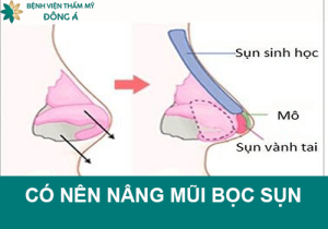 Có nên nâng mũi bọc sụn không? Bọc sụn mũi nên chú ý điều gì?