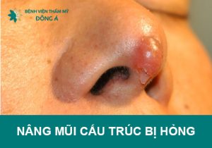 Có sửa được nâng mũi cấu trúc bị hỏng không?