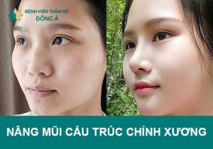 Nên hay không nâng mũi cấu trúc chỉnh xương?