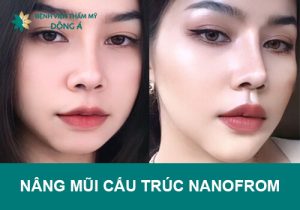 Tìm hiểu nâng mũi cấu trúc Nanoform