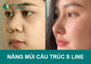 Nâng mũi cấu trúc S Line chuẩn đẹp tinh tế tại Đông Á