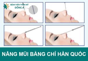 Nâng mũi bằng chỉ Hàn Quốc phương pháp không cần phẫu thuật