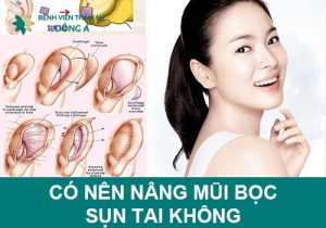 Có nên nâng mũi bọc sụn tai không? Giải đáp từ chuyên gia