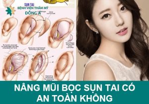 Nâng mũi bọc sụn tai có an toàn không? Có vĩnh viễn không?