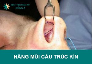 Nâng mũi cấu trúc kín có tốt không?