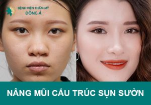 Tìm hiểu phương pháp nâng mũi cấu trúc sụn sườn