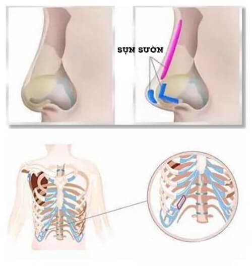 Nâng mũi sụn sườn có đau không