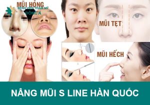 Nâng mũi Hàn Quốc S line – Mũi đẹp tự nhiên chuẩn Hàn