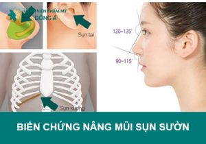 Biến chứng nâng mũi sụn sườn có thể gặp