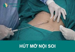 Hút mỡ nội soi
