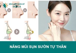 Nâng mũi sụn sườn tự thân – Giải cứu chiếc mũi kém duyên