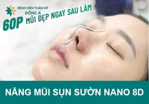 Nâng mũi sụn sườn Nano 8D