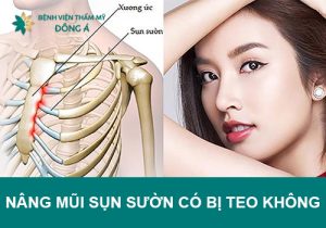 Nâng mũi sụn sườn có bị teo lại không