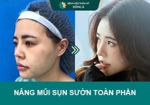 Nâng mũi sụn sườn toàn phần – Xu hướng nâng mũi an toàn và hiệu quả