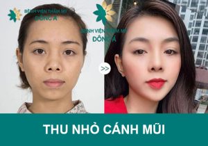 Thu nhỏ cánh mũi – Giải pháp giúp khuôn mặt cân đối, hài hòa.