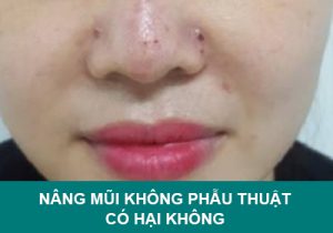 Nâng mũi không phẫu thuật có hại không? Giải đáp của chuyên gia