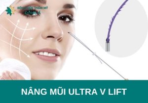 Nâng mũi Ultra V Lift là gì? Có tốt không? Có vĩnh viễn không?