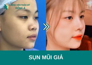 Sụn mũi giả là gì? Nên nâng mũi sụn giả hay sụn tự thân