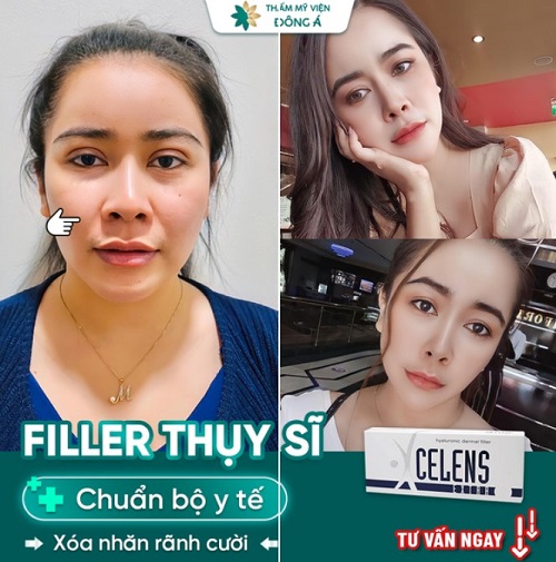 Tiêm filler Đông Á ở Cần Thơ