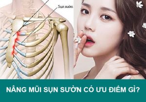 Nâng mũi sụn sườn có ưu điểm gì