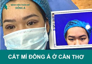 Cắt mí Đông Á ở Cần Thơ – Cải thiện đôi mắt kém duyên uy tín