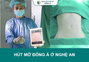 Hút mỡ Đông Á ở Nghệ An – Địa chỉ “vàng” giúp loại bỏ mỡ thừa nhanh chóng, an toàn.