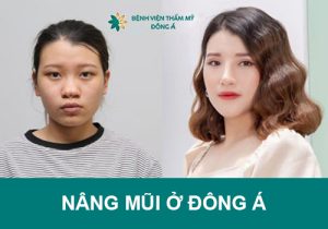 Dịch vụ nâng mũi ở Đông Á có an toàn không