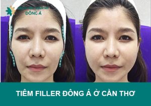 Có nên tiêm filler Đông Á ở Cần Thơ