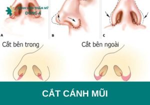 Phẫu thuật cắt cánh mũi là gì? Cắt cánh mũi có đau không?